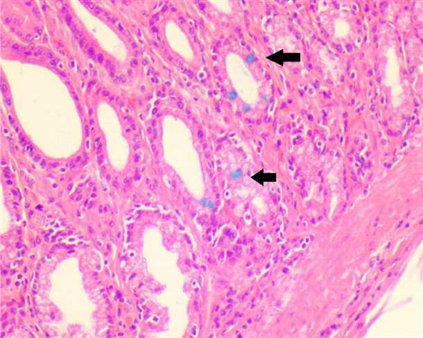 Intestinalna metaplazija želuca: simptomi, liječenje. Metaplazija pločastih stanica je ...